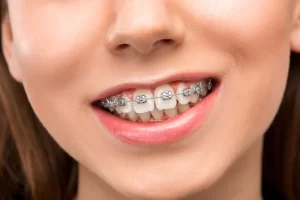What-is-the-oldest-age-for-braces