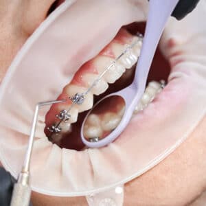 braces cost in massachusetts