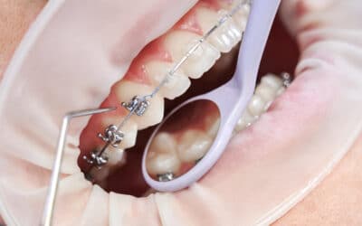 Braces Taunton MA: The Best Place to Get Braces in Taunton