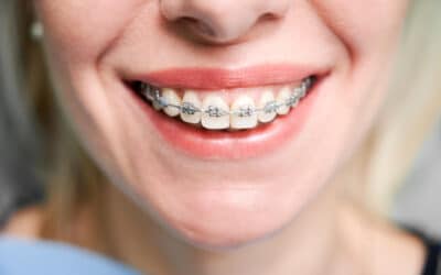 Braces Taunton: Get the Perfect Smile from a Plymouth Office