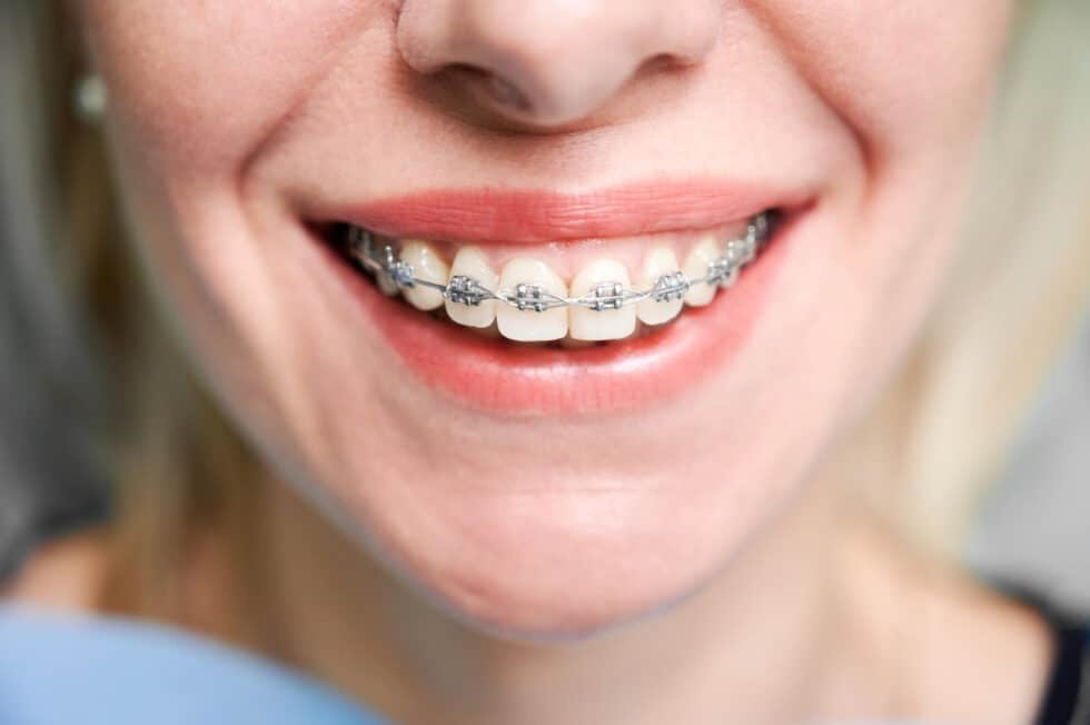 Braces Taunton: Key to a Perfect Smile - Plymouth Orthodontics